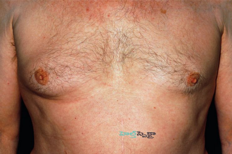 Diagnosing male breast cancer