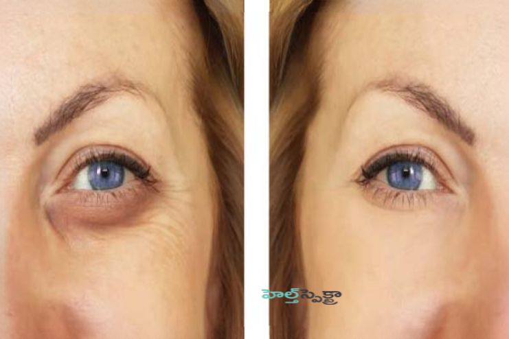 Eyelid surgery