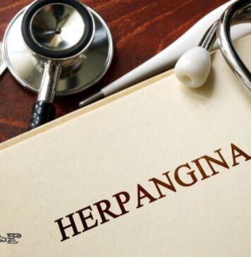 హెర్పాంగినా: కారకాలు, లక్షణాలు, చికిత్స మరియు నివారణ Herpangina_ Symptoms, Causes, Treatment and Prevention