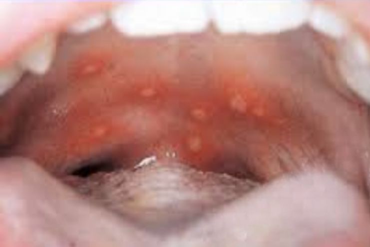 How common is herpangina