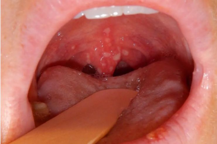 How does herpangina affect children