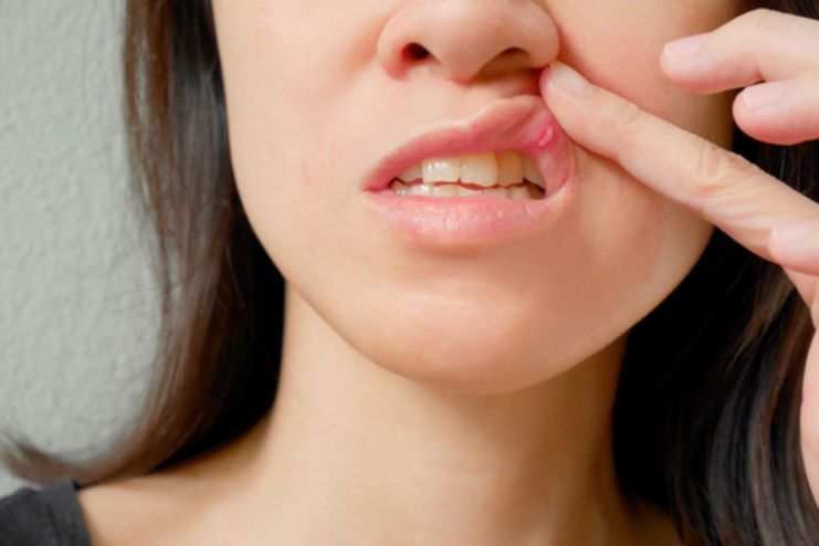 How long does herpangin