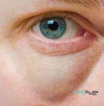 కళ్ల కింద సంచుల ఆకారాలు: లక్షణాలు, కారకాలు, చికిత్స, నివారణ Puffy Eyes_ Causes, Symptoms, and Treatment