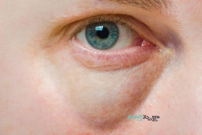 Puffy Eyes_ Causes, Symptoms, and Treatment