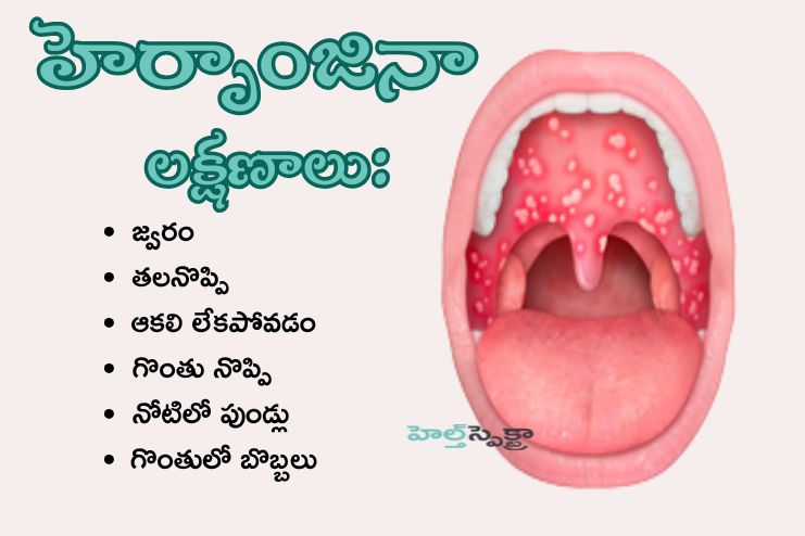 Symptoms of herpangina