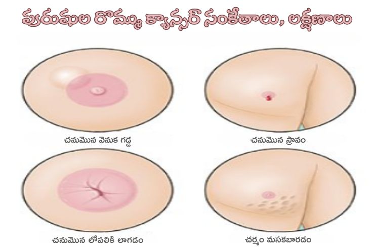 Symptoms of male breast cancer