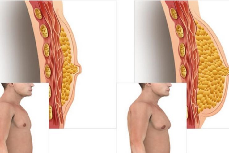 Types of male breast cancer