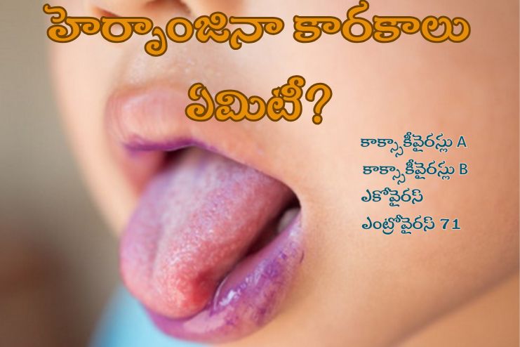 What causes Herpangina