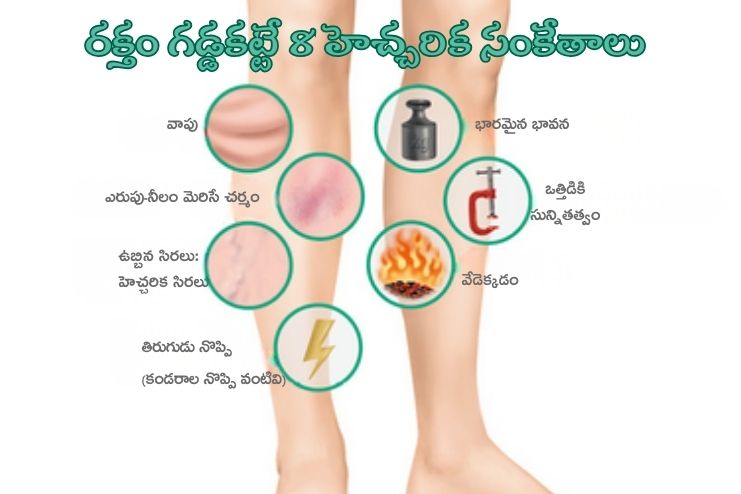 Are these 8 Warning Signs of Deep Blood Clots Dangerous 2