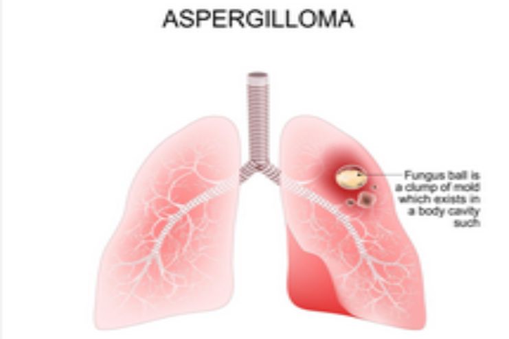Aspergilloma