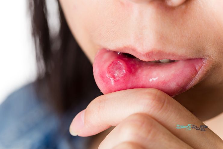 Beneficial in Ulcers