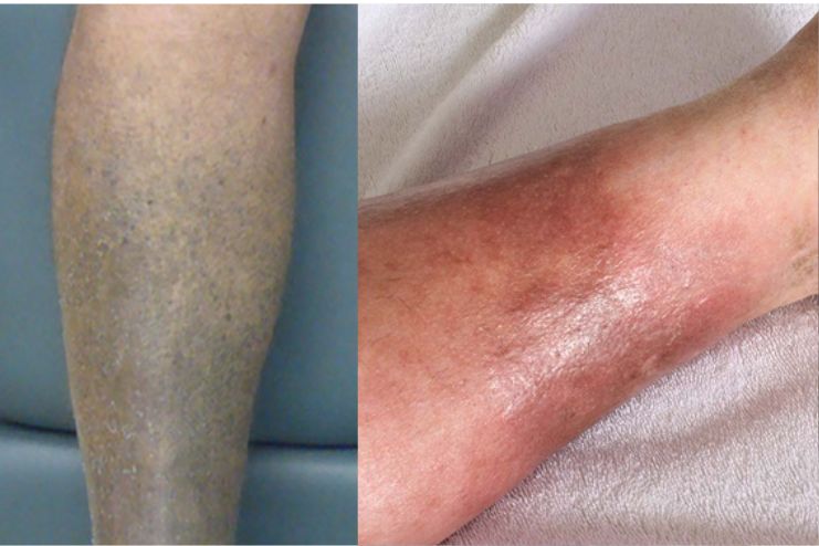 Blue or Red Skin in One Limb