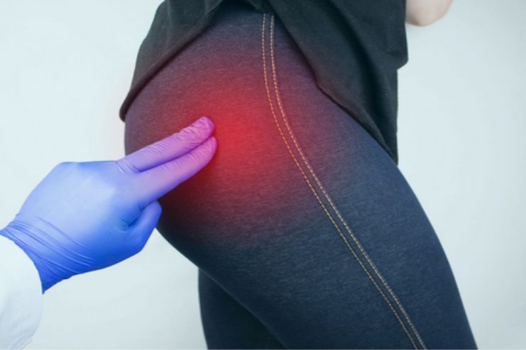 Buttock pain treatment