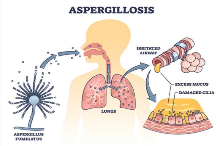 Causes of Aspergillosis