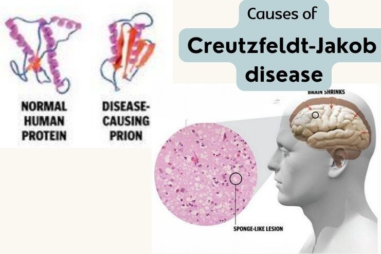 Causes of of Creutzfeldt-Jakob diseas