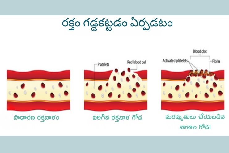 Clots and Blood Vessel Types