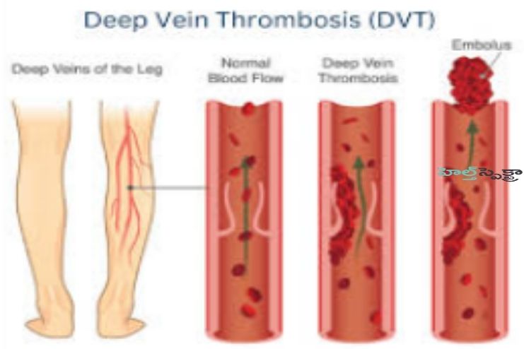 Complications of a DVT