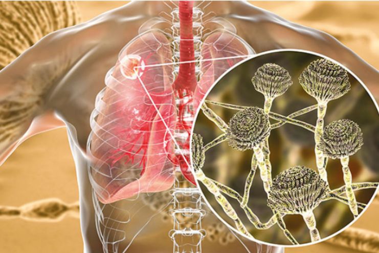 Diagnosis of Aspergillosis