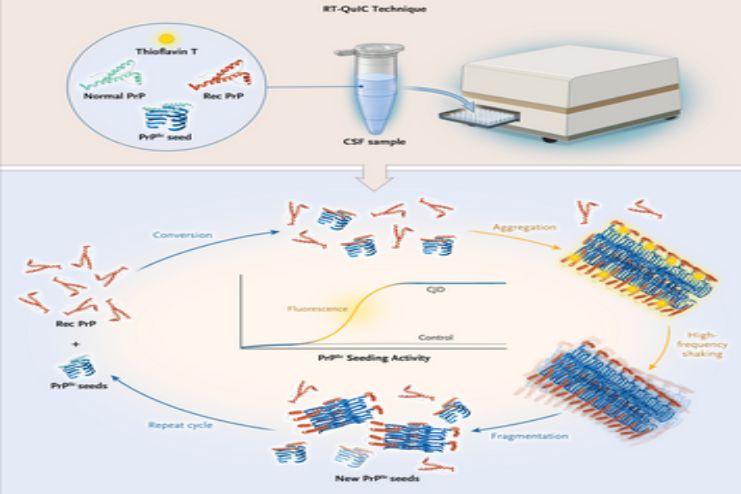 Diagnosis of Creutzfeldt-Jakob diseas