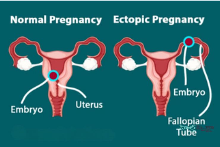 Ectopic pregnancy
