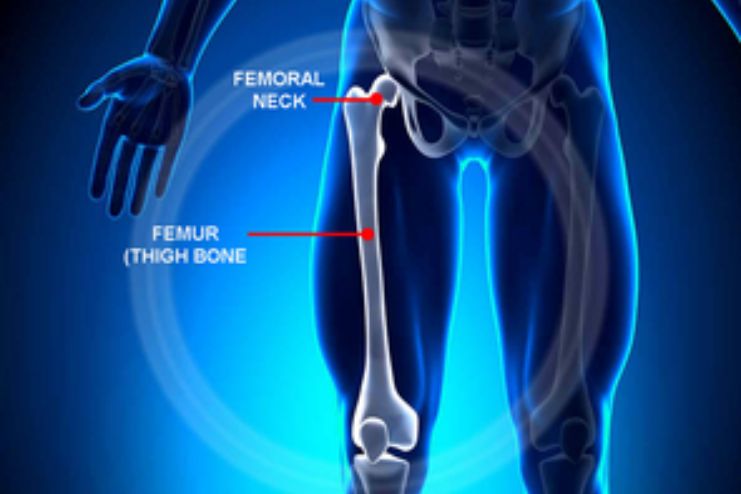 Femoral neck stress fracture