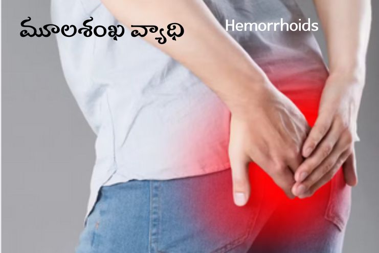 Hemorrhoids