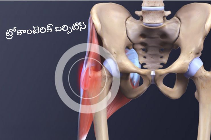 Hip Bursitis