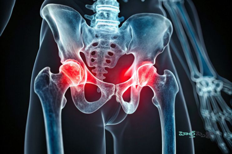 Hip osteonecrosis