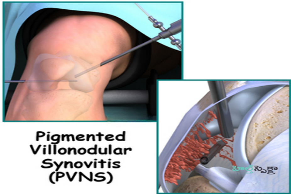 How Do You Treat PVNS