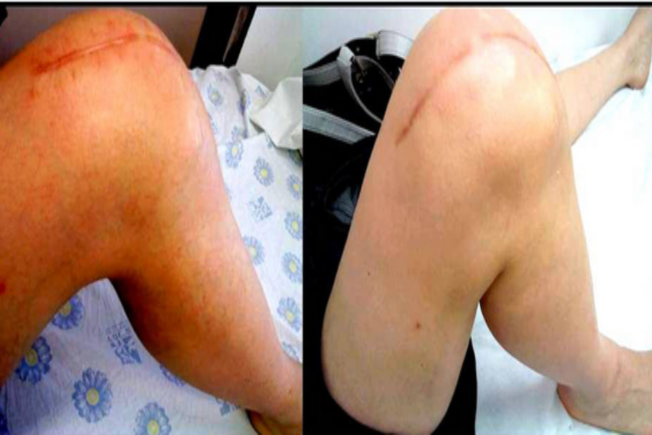 How effective is treatment