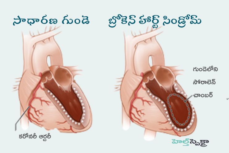 Impact of Broken Heart Syndrome