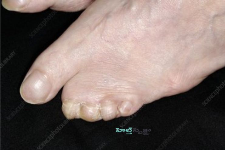 Living With Webbed Toes