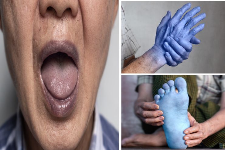 Other Symptoms With Cyanosis