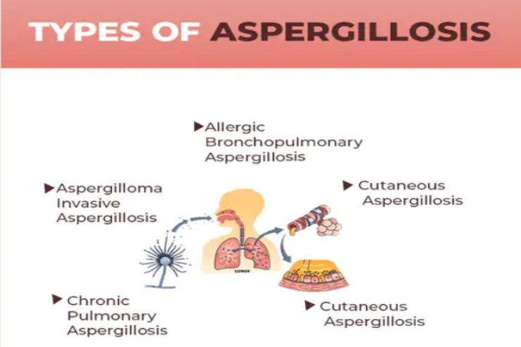 Other types of aspergillosis