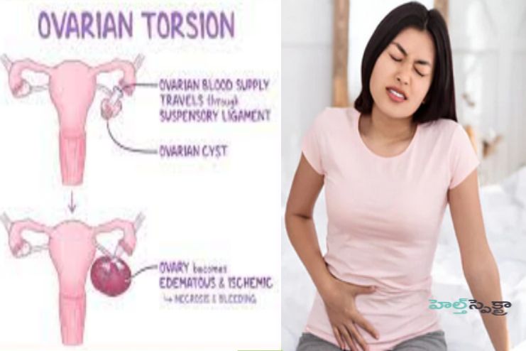 Ovarian torsion