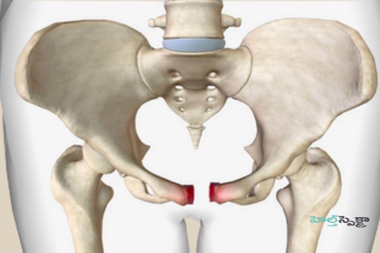 Pelvic fracture