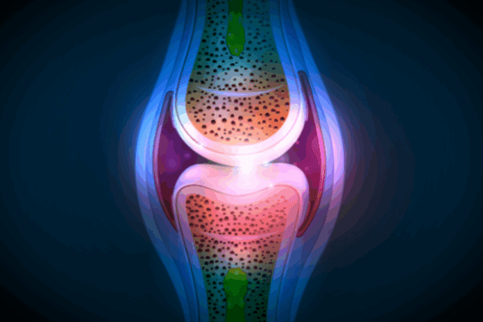 Pigmented Villonodular Synovitis (PVNS)