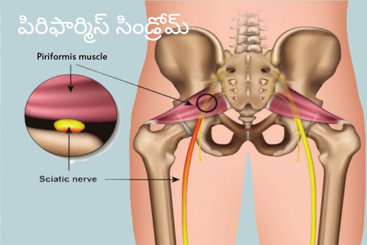 Piriformis Syndrome