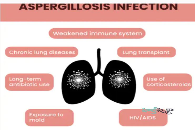 Risk factors of Aspergillosis
