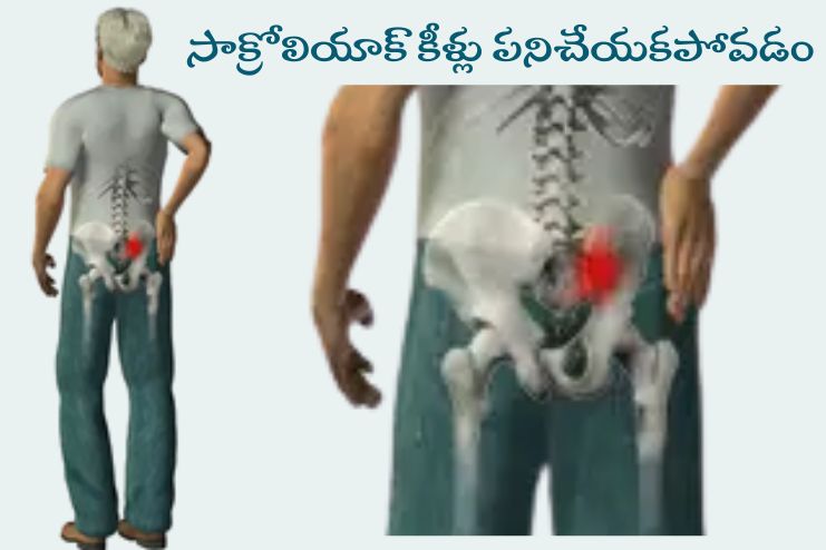 Sacroiliac Joint Dysfunction