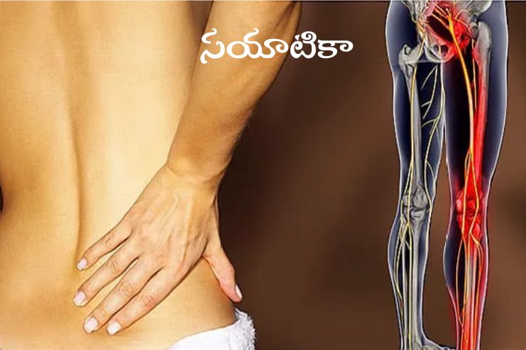 Sciatica