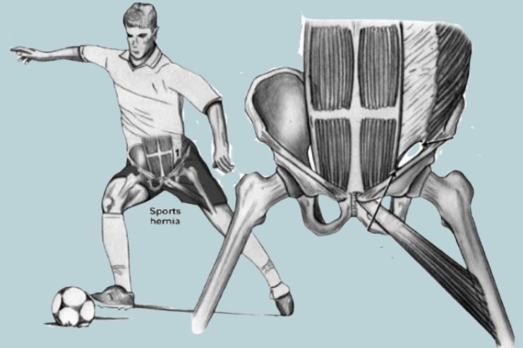 Sports hernia