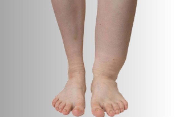 Swelling in One Limb