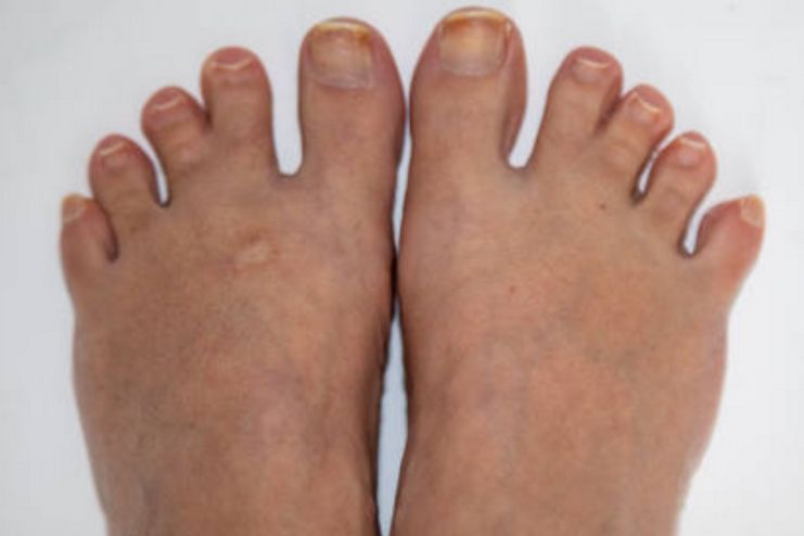 Symptoms for Webbed Toes