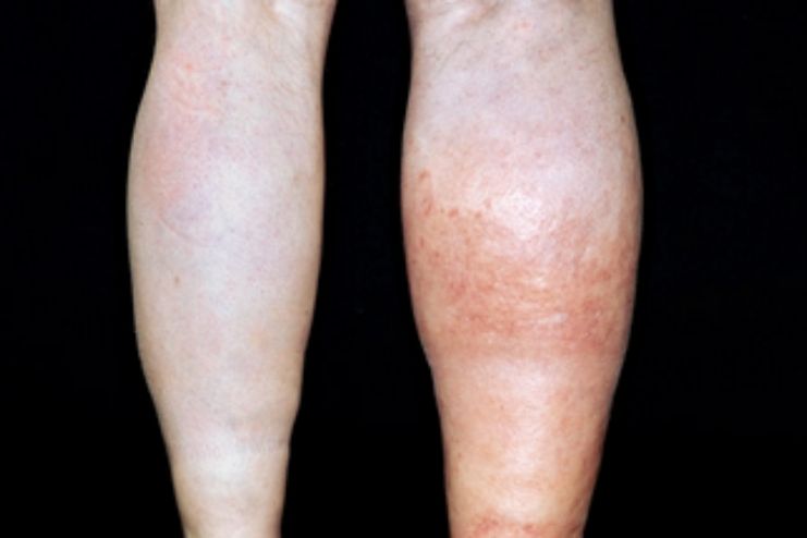 Symptoms of Blood Clot in legs