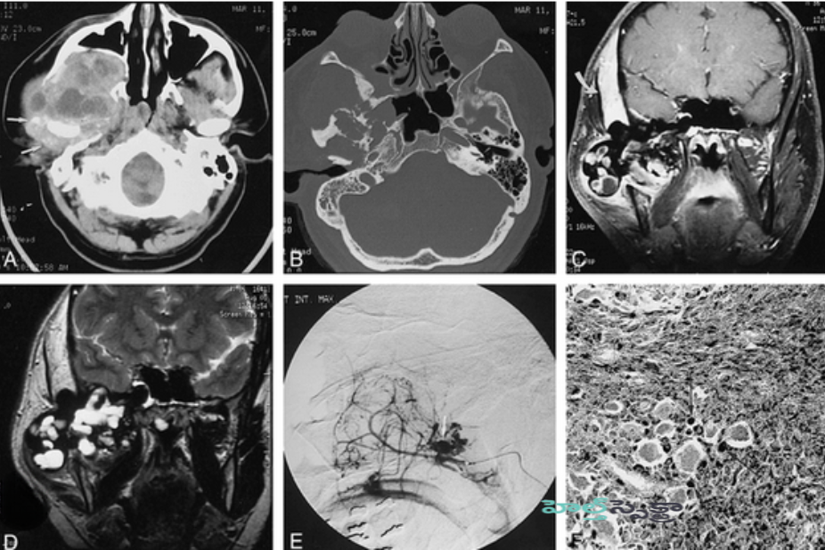 Tests to diagnose PVNS