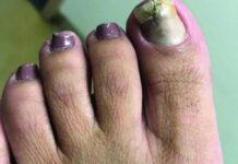 గోళ్లు నీలం రంగులోకి మారాయా.? ఈ భయంకర నిజం తెలుసా.? The Alarming Truth About Blue or Purple Nails