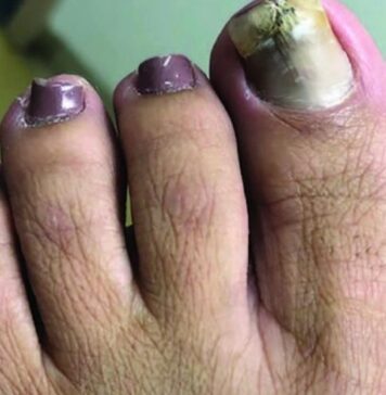 గోళ్లు నీలం రంగులోకి మారాయా.? ఈ భయంకర నిజం తెలుసా.? The Alarming Truth About Blue or Purple Nails