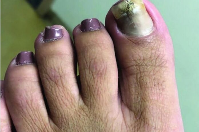 The Alarming Truth About Blue or Purple Nails