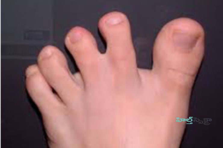 Types of Webbed Toes